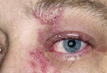 Shingles vaccine-princ_photo_of_shingles_rash_on_eye.jpg